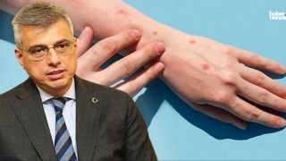 Sağlık Bakanı Memişoğlu'ndan Maymun Çiçeği Açıklaması: 'Ülkemizde Tanı Yok'