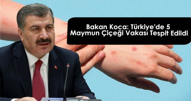 Bakan Koca: Türkiye'de 5 Maymun Çiçeği Vakası Tespit Edildi