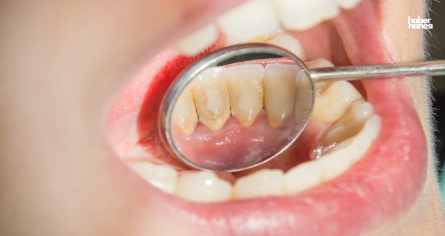 Diş Tartarları ve Sağlık: Önlemler ve Tedaviler