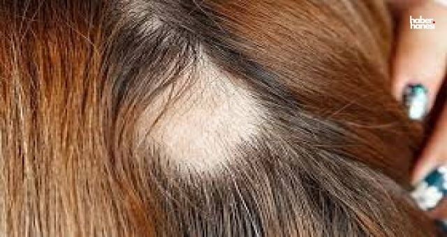Saç Yolma Hastalığı Trikotillomani Nedenleri, Belirtileri Tedavisi Nedir?