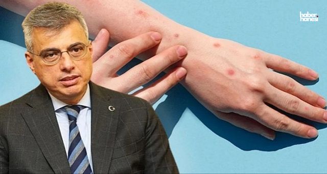 Sağlık Bakanı Memişoğlu'ndan Maymun Çiçeği Açıklaması: 'Ülkemizde Tanı Yok'