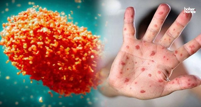 Maymun Çiçeği Virüsü Havuz, Deniz ve Kaplıcalarda Bulaşır mı?
